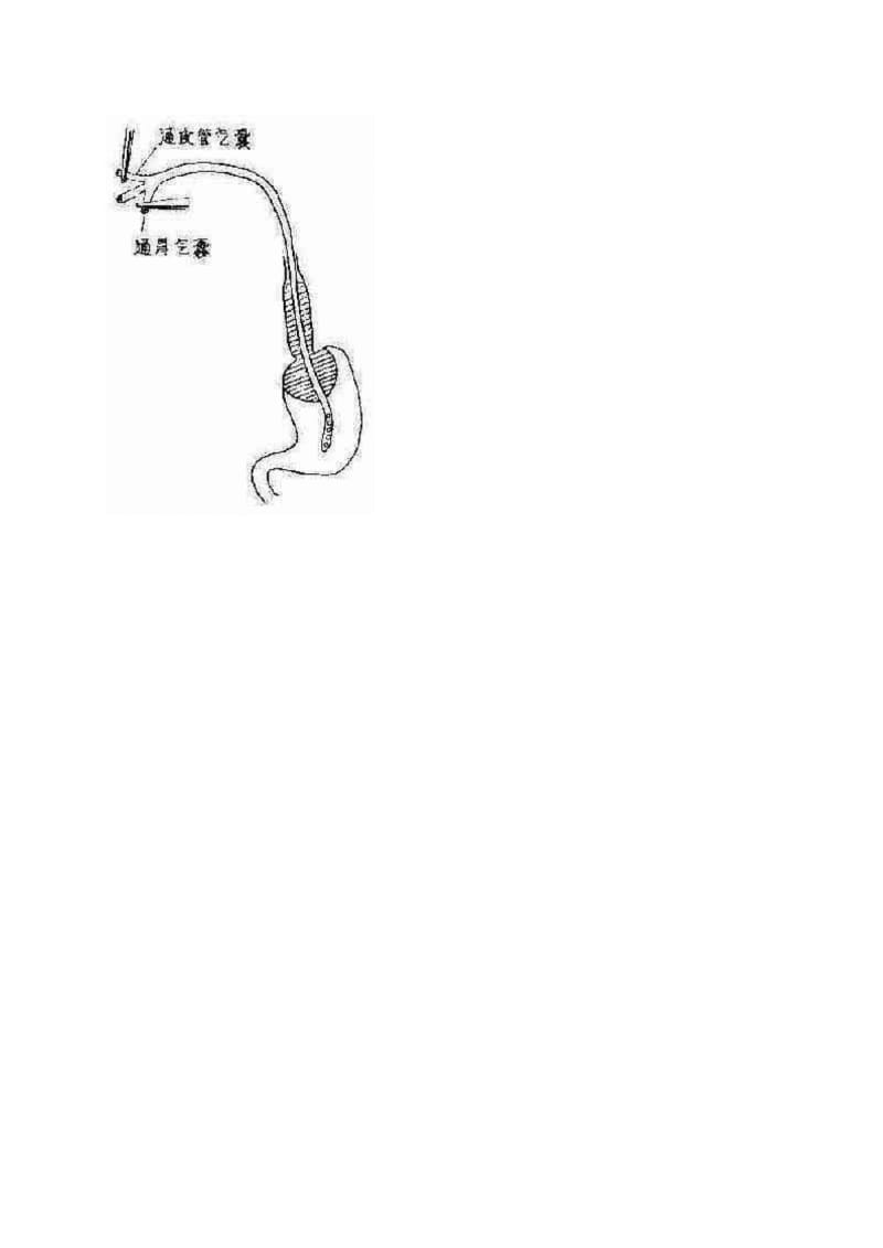 三腔二囊管压迫止血操作流程图.pdf_第3页