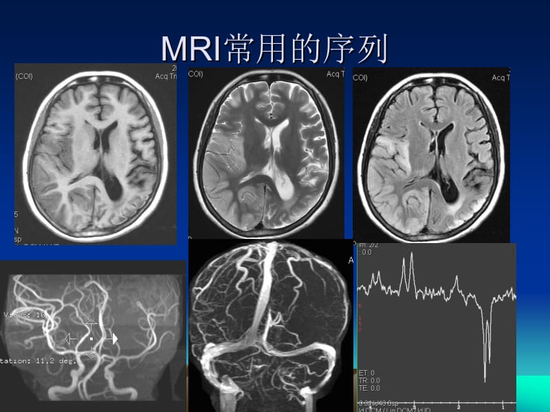 MRI头部断层名师编辑PPT课件.ppt_第2页
