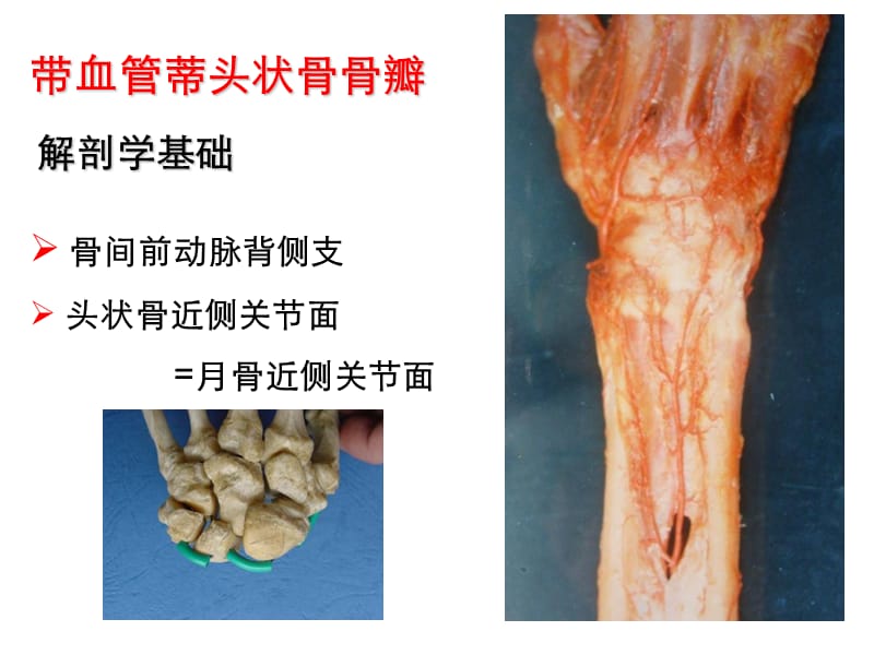 带血管蒂头状骨骨瓣治晚期课件-文档资料.ppt_第2页