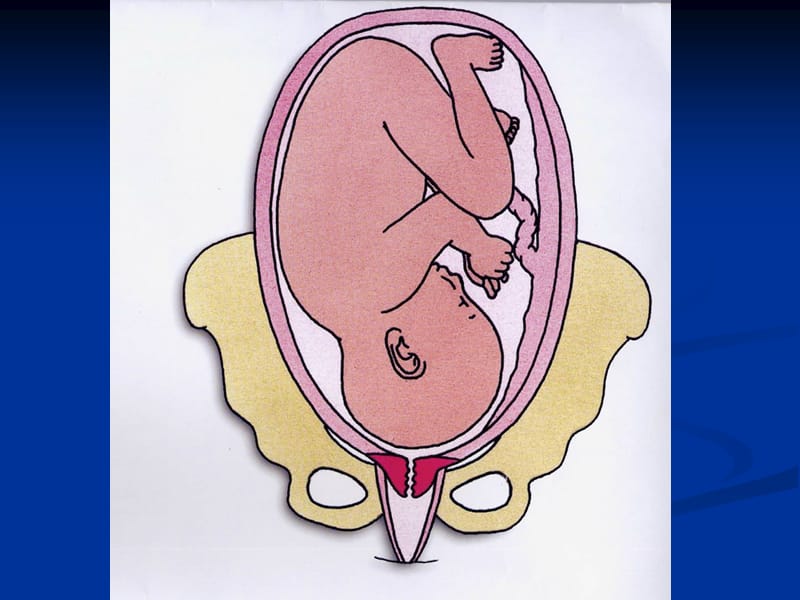 剖宫产术中胎儿损伤-PPT文档.pptx_第3页