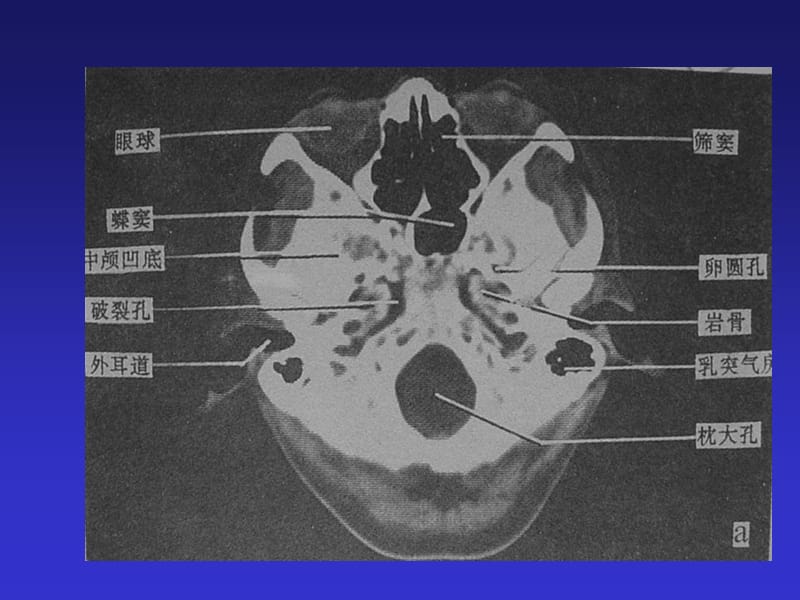 最新头颅、胸部CT-PPT文档.ppt_第1页