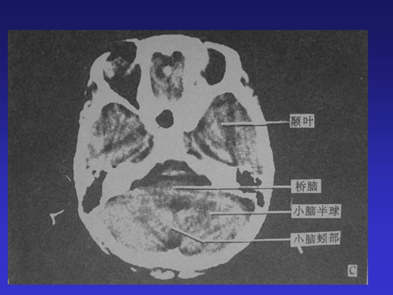 最新头颅、胸部CT-PPT文档.ppt_第3页