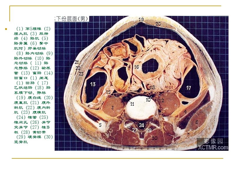 人体断层解剖图谱盆腔-文档资料.ppt_第3页