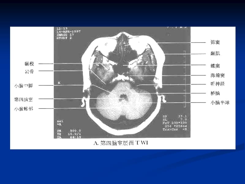 中枢神经系统常见肿瘤的MRI诊断-安徽医科大学第一附属医院钱银锋.ppt_第2页