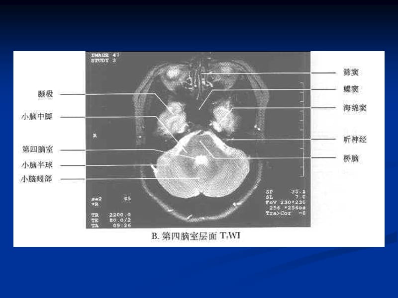 中枢神经系统常见肿瘤的MRI诊断-安徽医科大学第一附属医院钱银锋.ppt_第3页