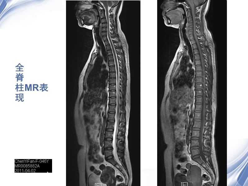 医学影像-脊柱外伤影像学表现.ppt_第3页