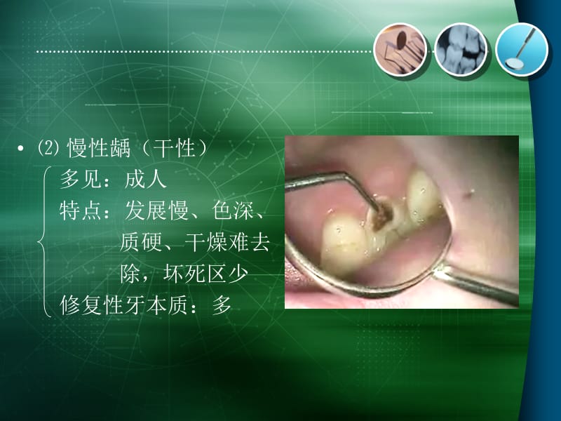 龋病的分类和临床表现.ppt_第3页