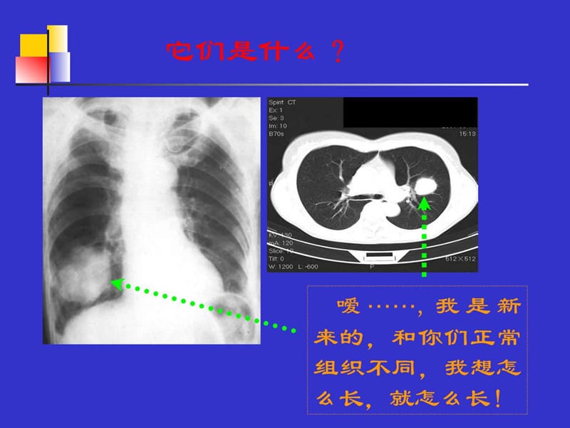 原发性支气管肺癌(1).ppt_第2页