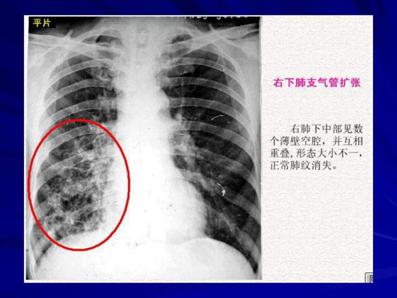 肺与纵隔疾病_临床医学_医药卫生_专业资料.ppt_第3页