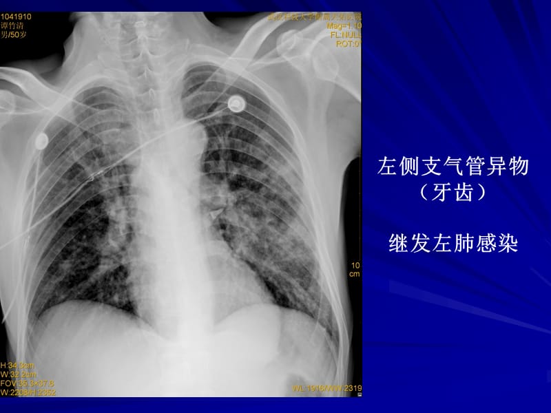 呼吸系统常见疾病影像诊断ppt课件.ppt_第3页