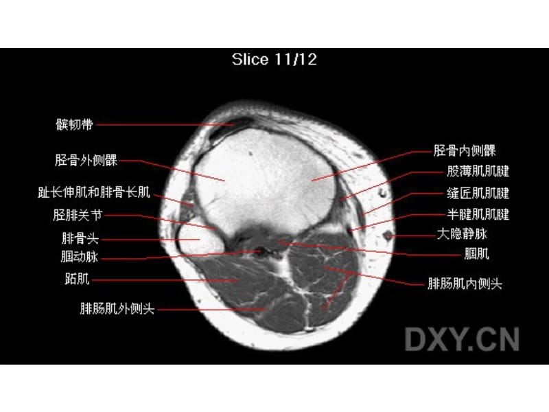 《膝部MRI解剖》PPT课件.ppt_第2页