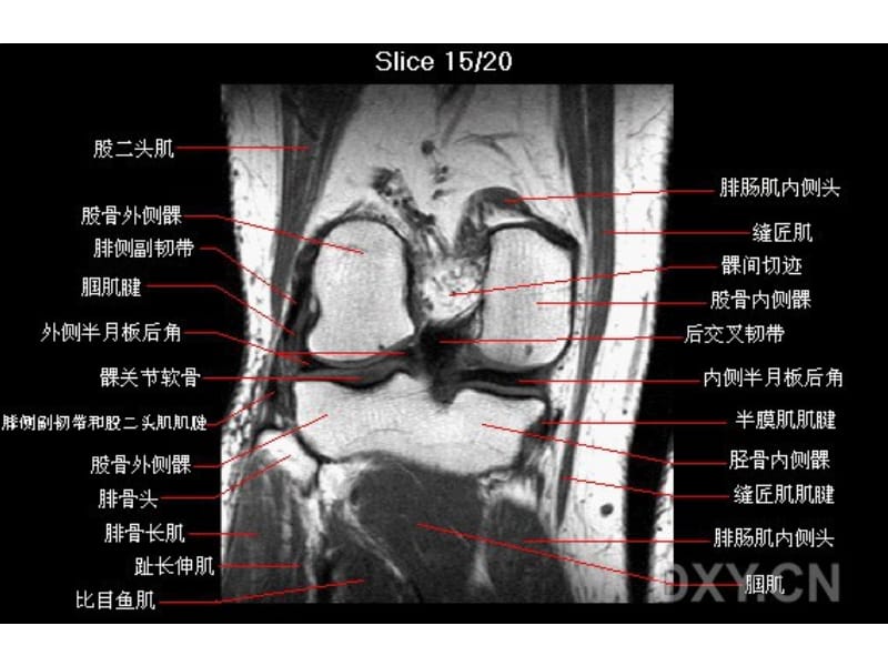 《膝部MRI解剖》PPT课件.ppt_第3页