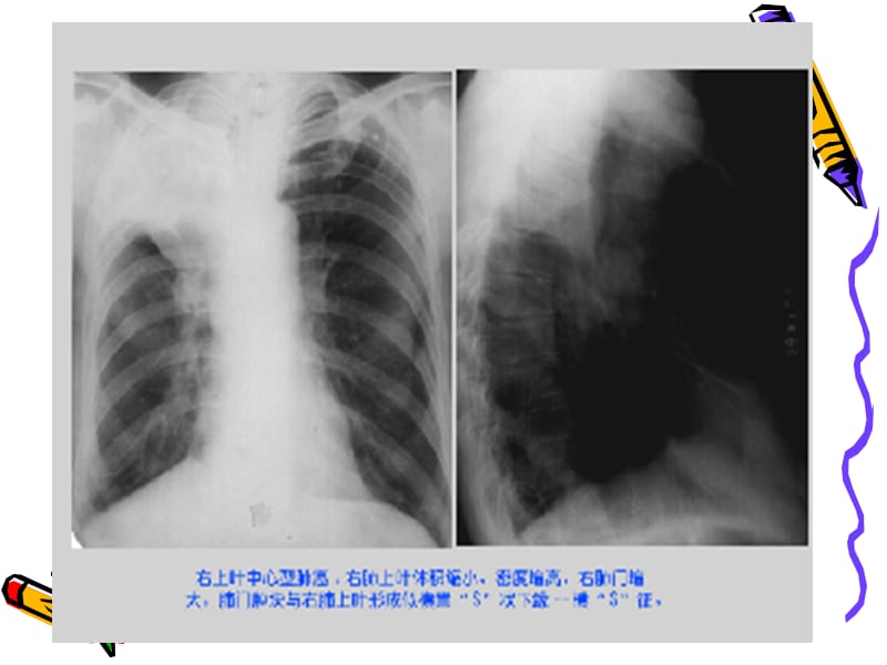 《肺癌》PPT课件.ppt_第3页