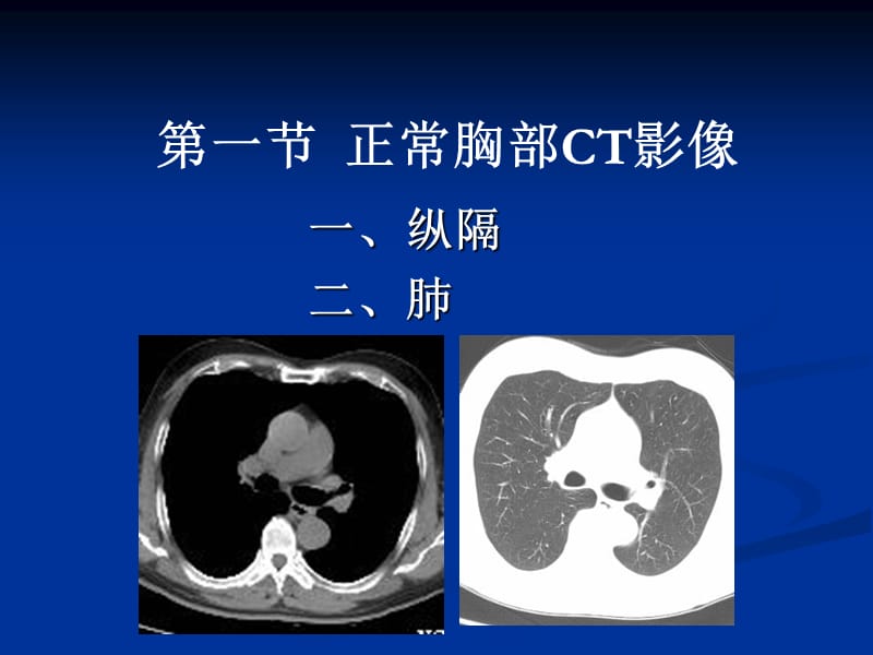 胸部疾病CT诊断PPT课件.ppt_第2页