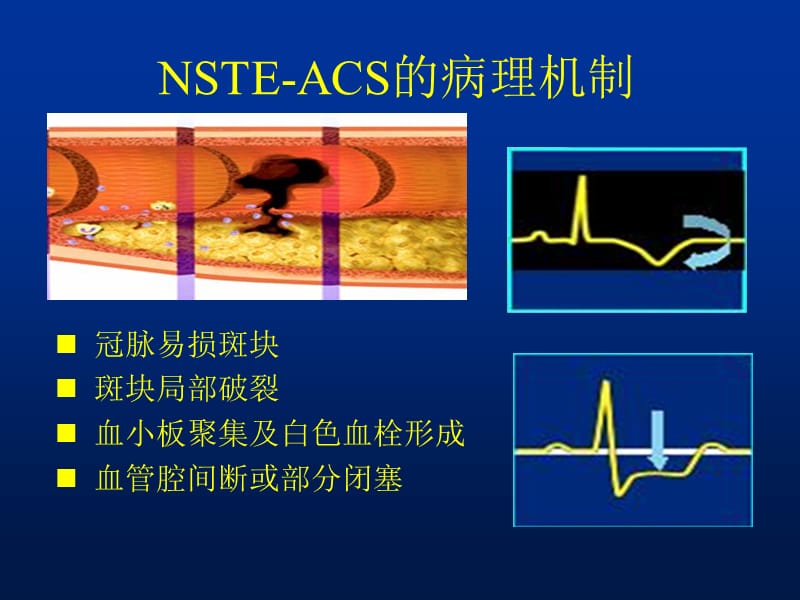 nste-acs多支血管病变靶血管的判定.ppt_第2页