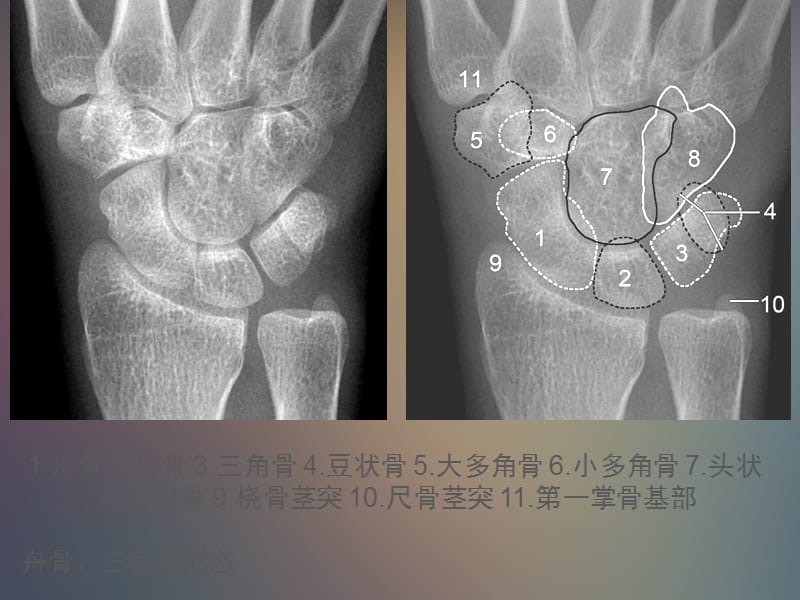 《腕关节解剖》ppt课件.ppt_第3页