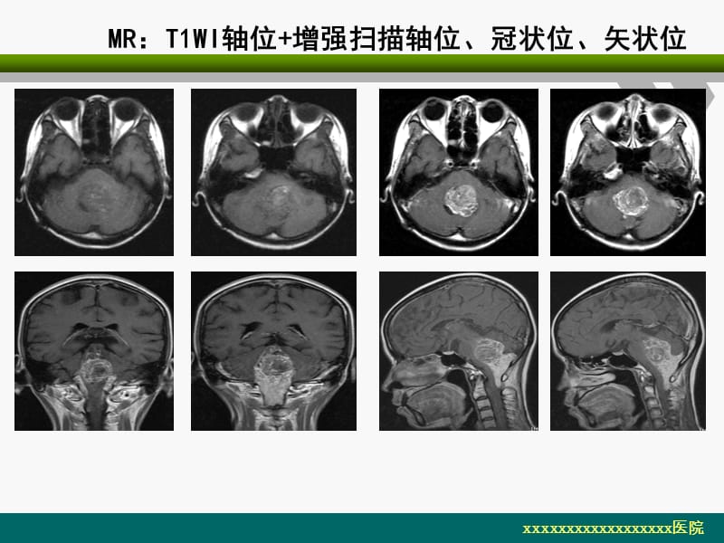 脑室内室管膜瘤的影像诊你断及鉴别_.ppt_第3页