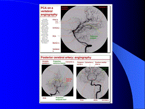 脑血管解剖与影像学-2.ppt