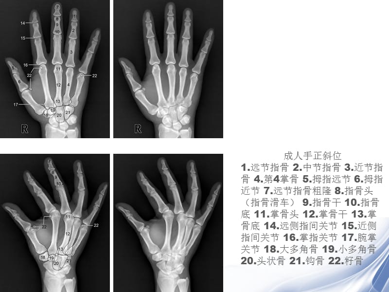 医学影像-四肢关节正常变异、常见病变及创伤的影像表现.ppt_第3页