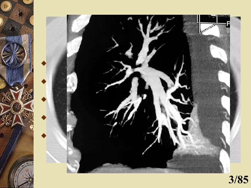 肺部CT诊断.ppt_第3页