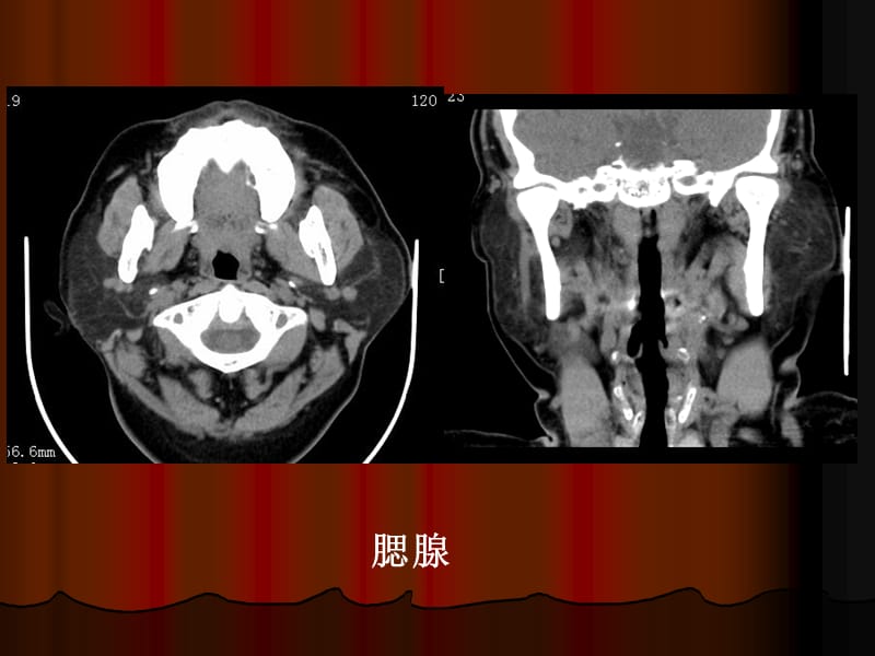 颌面部正常及异常的CT诊断.ppt_第3页