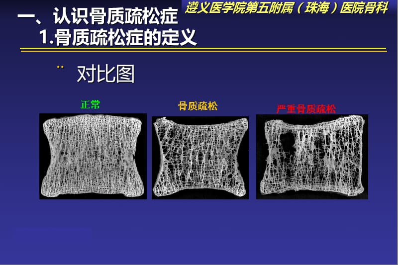 骨质疏松症的防治及药物治疗呢-2012年珠海骨科峰会PPT课件.ppt_第3页