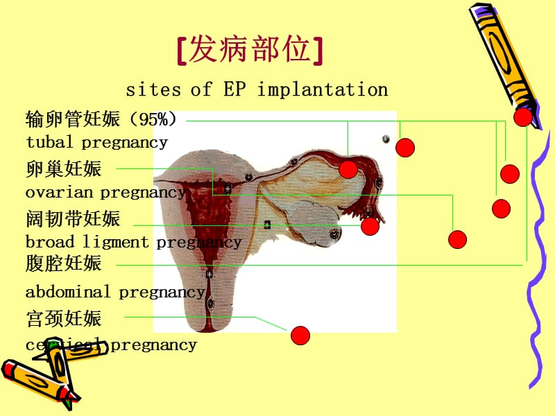 异位妊娠的超声诊断.ppt_第3页