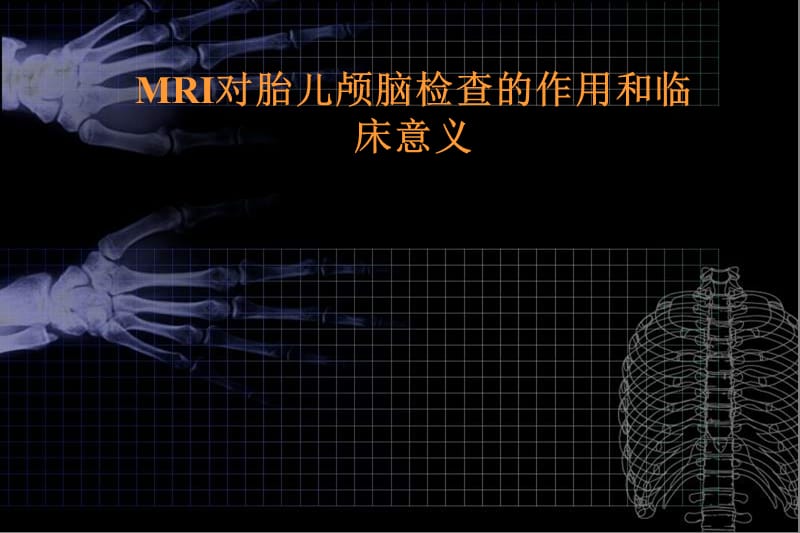 MRI对胎儿颅脑检查的作用和临床意义.ppt_第1页