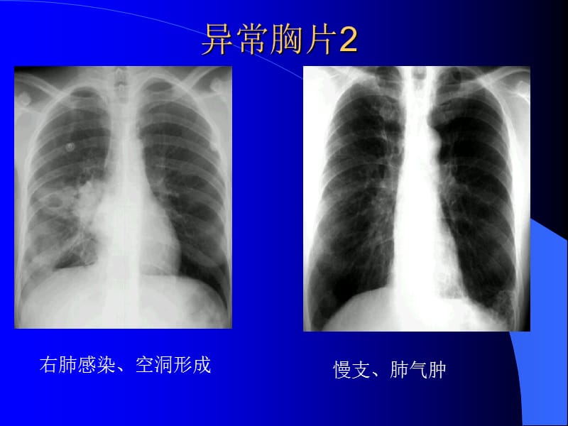 呼吸系统X线CT读片技巧.ppt_第3页