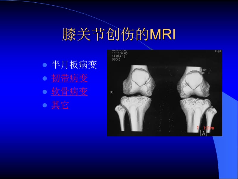 MRI在膝关节创伤的应用.ppt_第1页