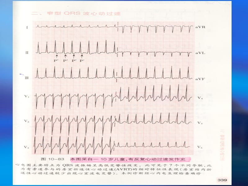 内科临床教学jx14-3.心脏急症疑难心电图 4c-心电图图例.ppt_第3页