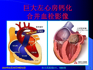 巨大左心房钙化合并血栓影像.ppt