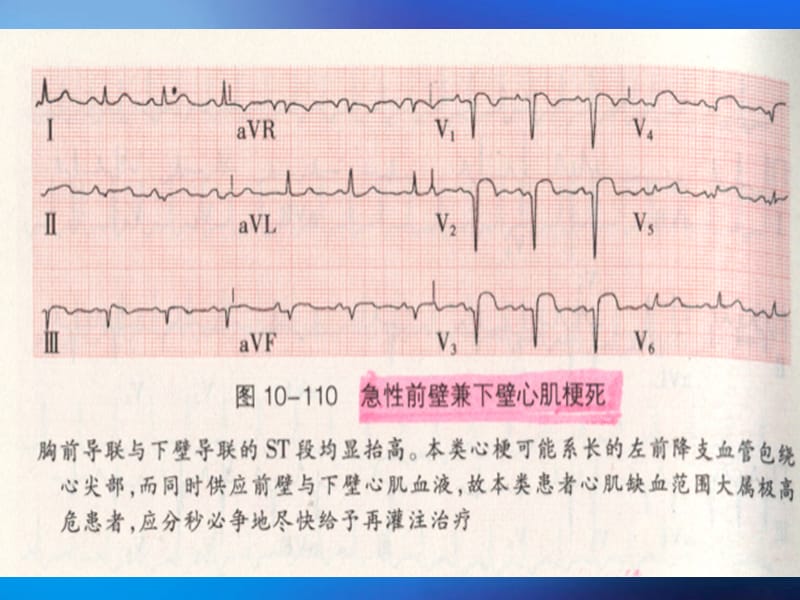 内科临床教学jx14-4.心脏jx急症疑心动图 4d-心电图图例.ppt_第3页