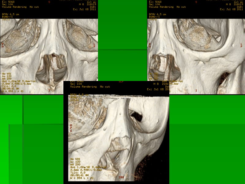 鼻骨解剖与骨折的CT表现.ppt_第3页