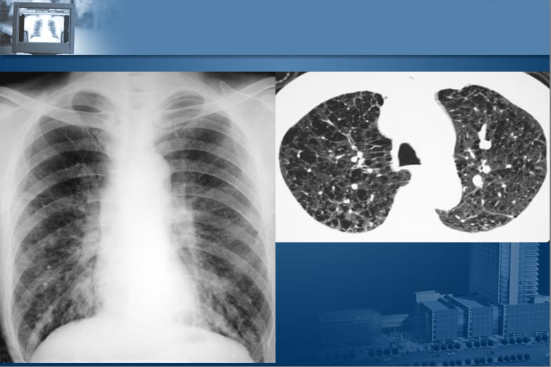 推荐医学影像诊断课件图文详解完整-呼吸系统影像学.ppt_第3页