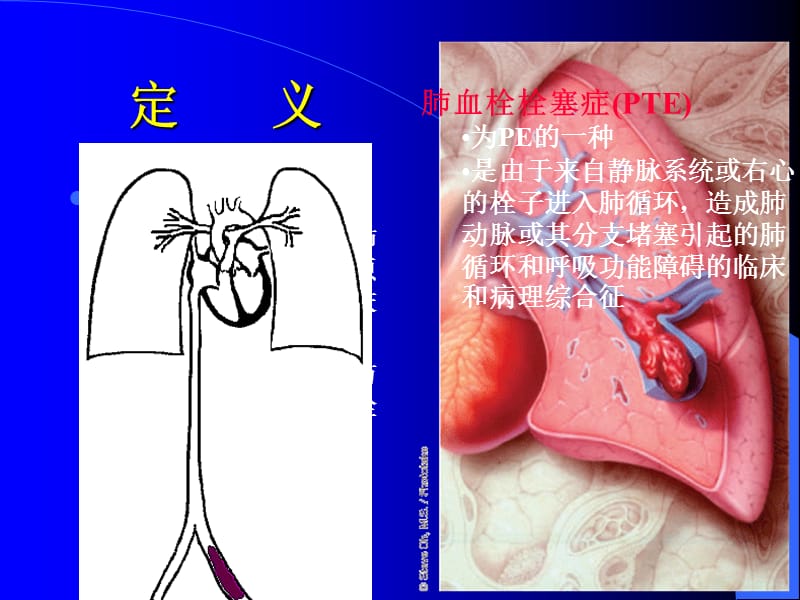 肺栓塞治疗和预防新疆icu进展2009 ppt课件.ppt_第2页