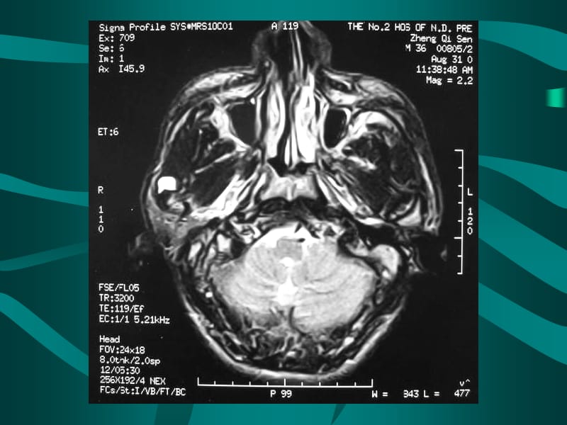 颅脑外伤的CT诊断-影像学课件.ppt_第2页