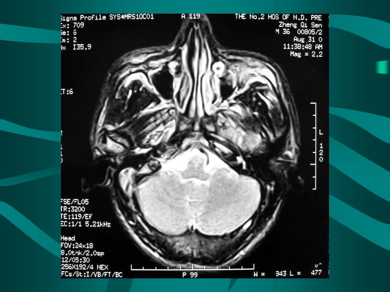 颅脑外伤的CT诊断-影像学课件.ppt_第3页