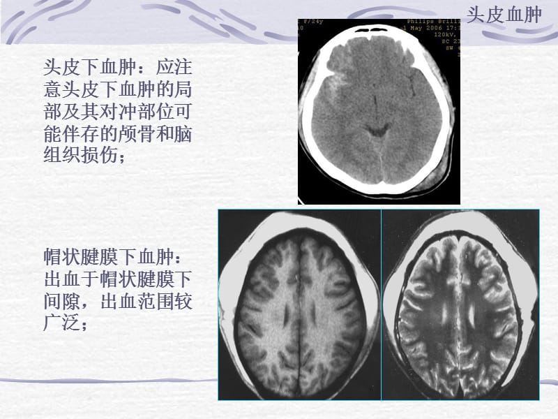 颅脑外伤的CT表现.ppt_第3页