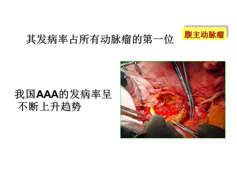 腹主动脉瘤.ppt_第3页