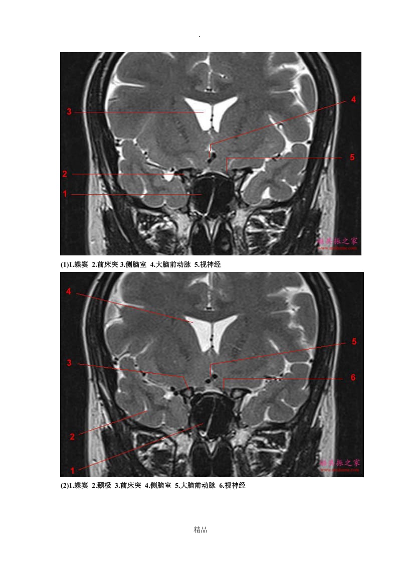 鞍区垂体MRI解剖.doc_第1页