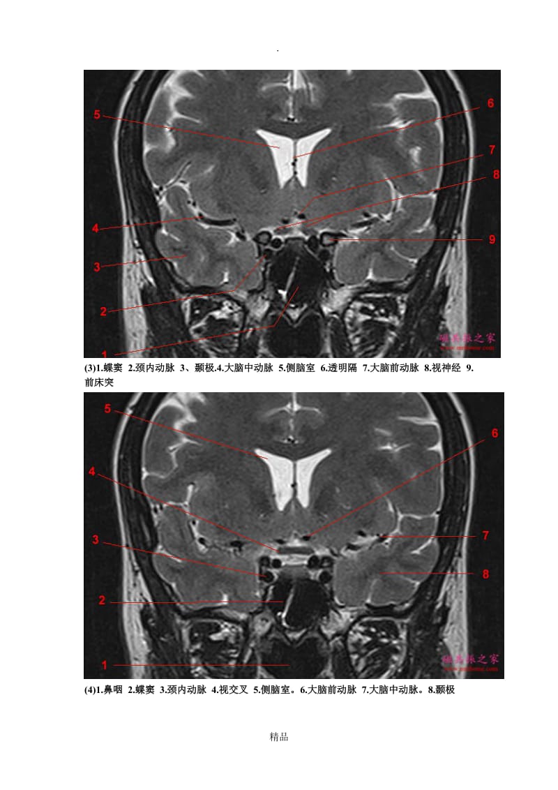鞍区垂体MRI解剖.doc_第2页