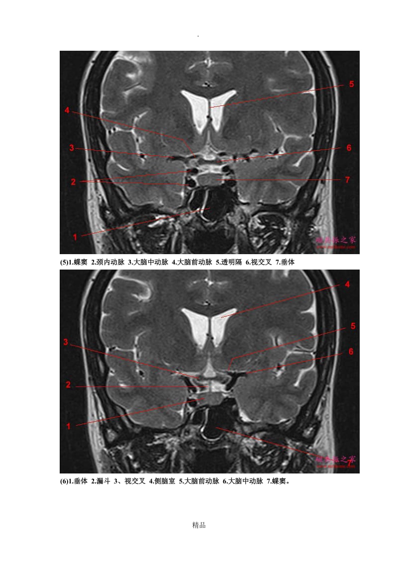 鞍区垂体MRI解剖.doc_第3页