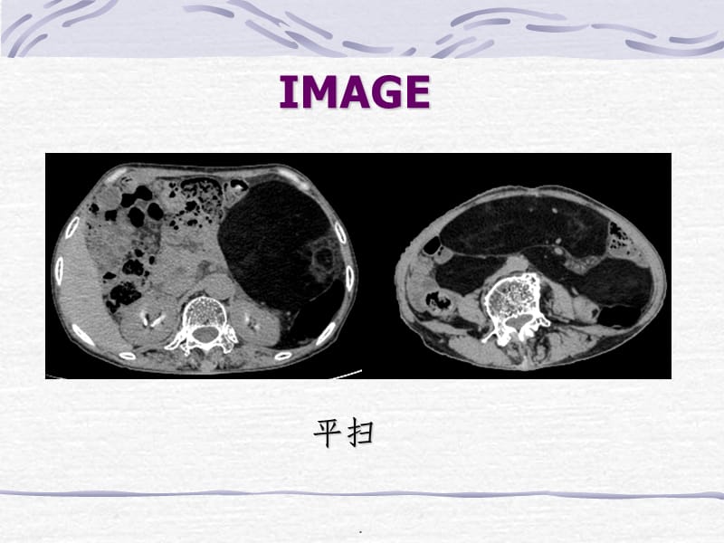 脂肪肉瘤一例CT表现.ppt_第2页