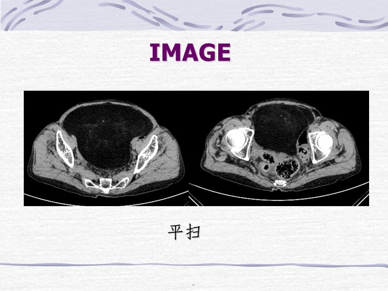 脂肪肉瘤一例CT表现.ppt_第3页