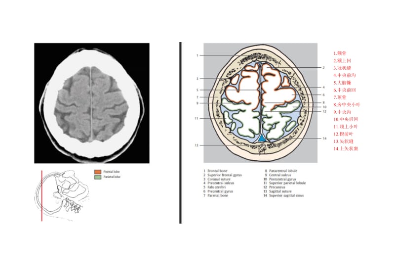 颅脑CT对照图谱.doc_第1页