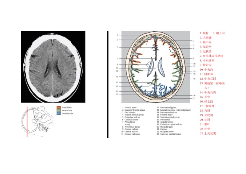 颅脑CT对照图谱.doc_第3页