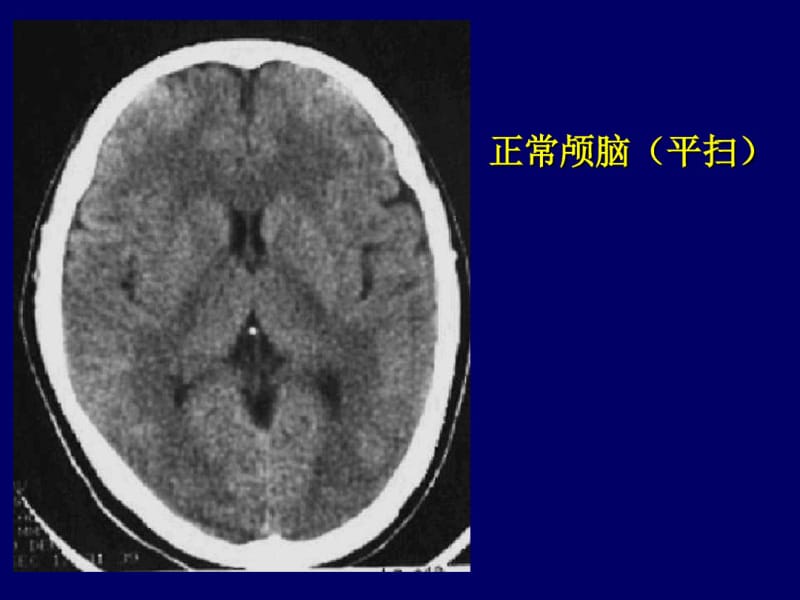 颅脑CT诊断读片.pdf_第2页