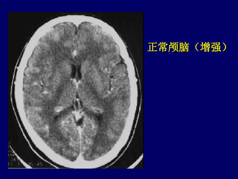 颅脑CT诊断读片.pdf_第3页