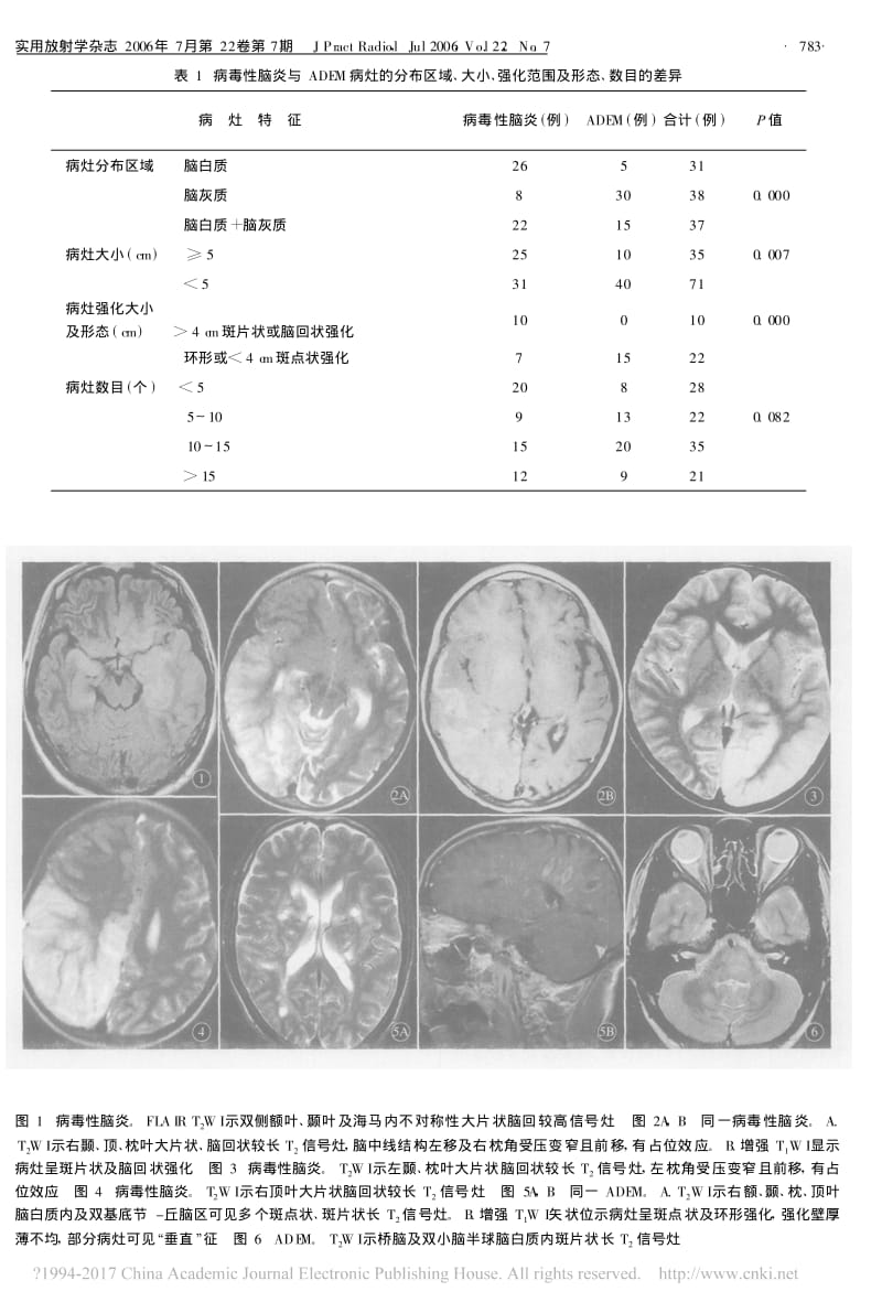 病毒性脑炎的MRI诊断.pdf_第3页
